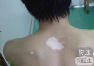 白癜风吃蛇瓜吗,营养与禁忌解析